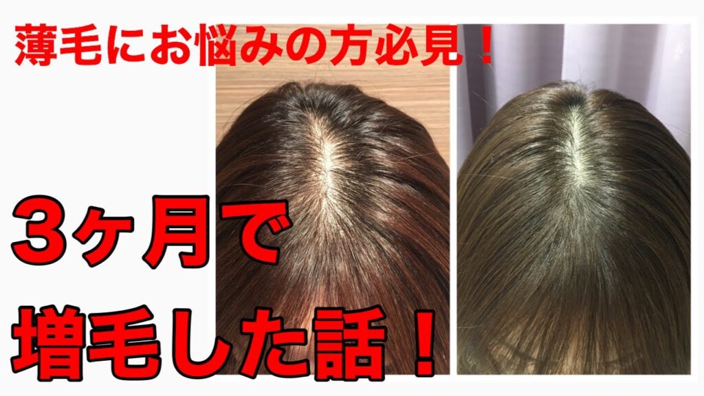 3ヶ月で増毛しました!!!