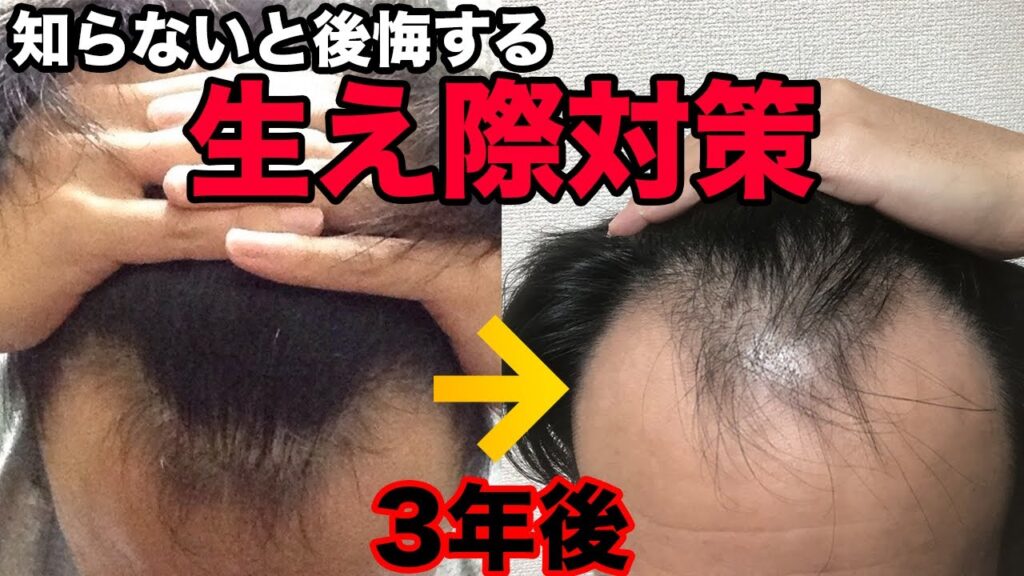 生え際の薄毛進行は止められる。そのために必要な生え際対策