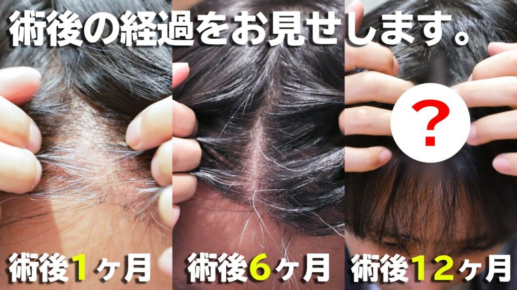 【自毛植毛 手術】術後1年の経過を報告します