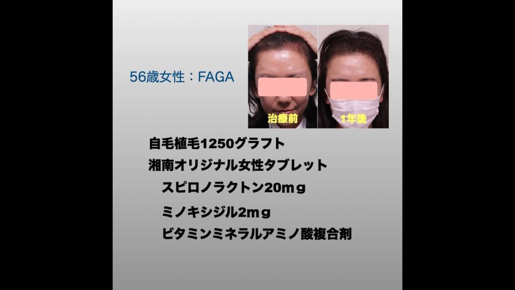 58歳女性FAGAの自毛植毛1250グラフト半年後