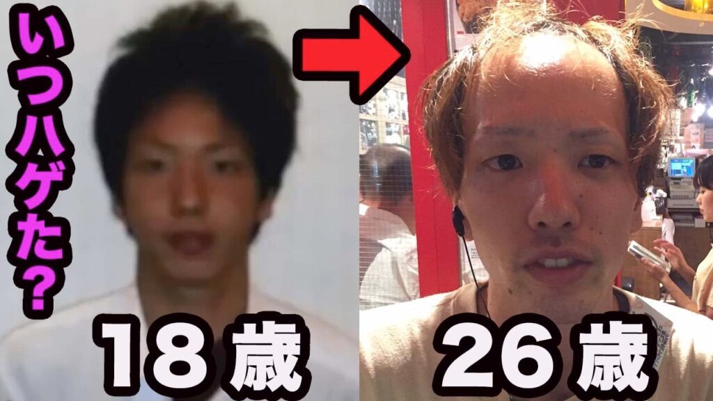 【おでこ生え際はいつ後退?】1年毎に過去写真振り返ってみた