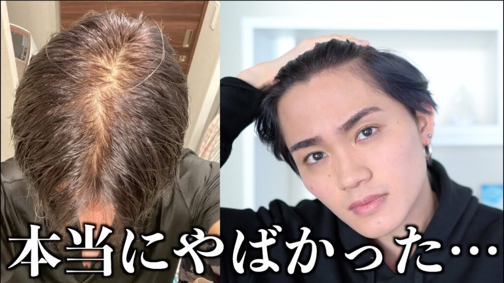 【初公開】薄毛アンチコメが酷すぎるので本当にAGA治療始めます。
