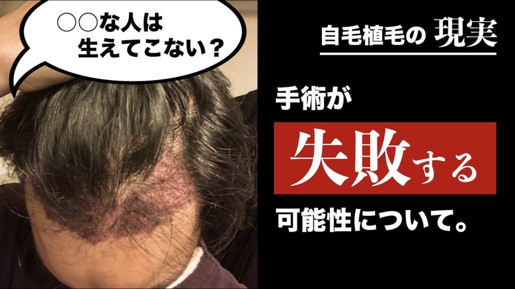 【元ハゲvs院長】自毛植毛が失敗するパターンについて聞きました。【AGA対策】