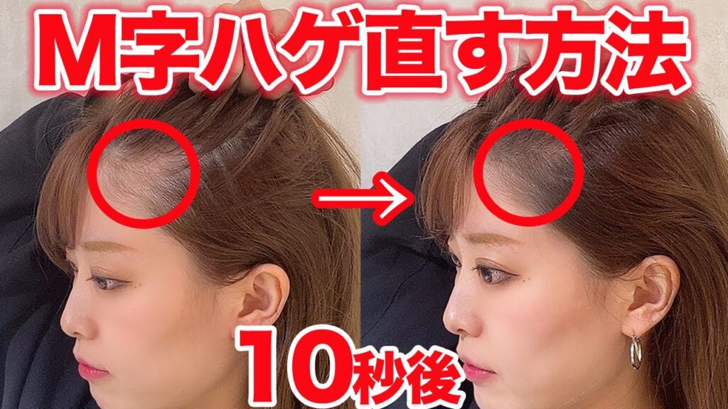 【M字ハゲ必見！】M字や生え際を自然に隠す方法！たった10秒で解決します！