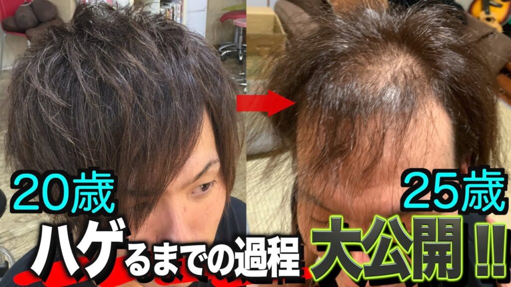 【おでこ、生え際】いつハゲたのか?過去の写真で振り返ってみた