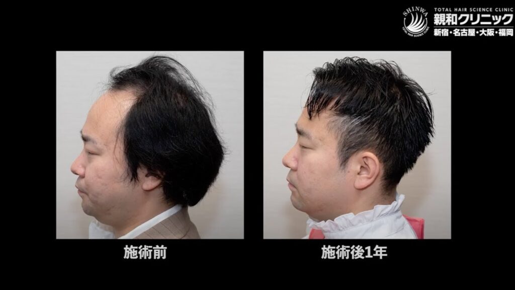 自毛植毛手術から12ヶ月後、生え際・前頭部・頭頂部に2000株移植「魔法を使ったみたい。人生が180度変わった」親和クリニック【 新宿・名古屋・大阪・福岡 】