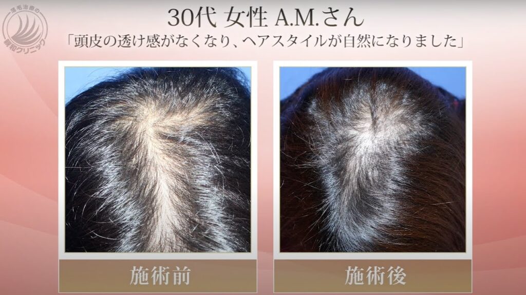 女性の自毛植毛の経過を5症例紹介致します 親和クリニック【 新宿・名古屋・大阪・福岡 】