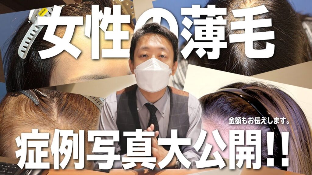 【薄毛治療】写真で解説する、女性の自毛植毛症例のビフォーアフター!【自毛植毛】
