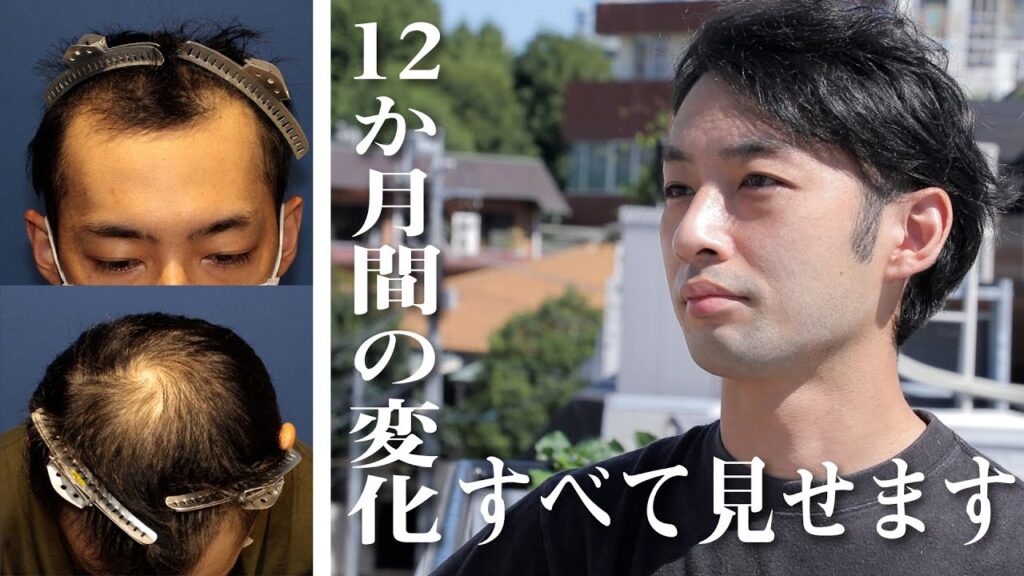 【自毛植毛 1年経過】術後1年経過し、自毛植毛手術が完成した今の率直な意見をお伺いしました。