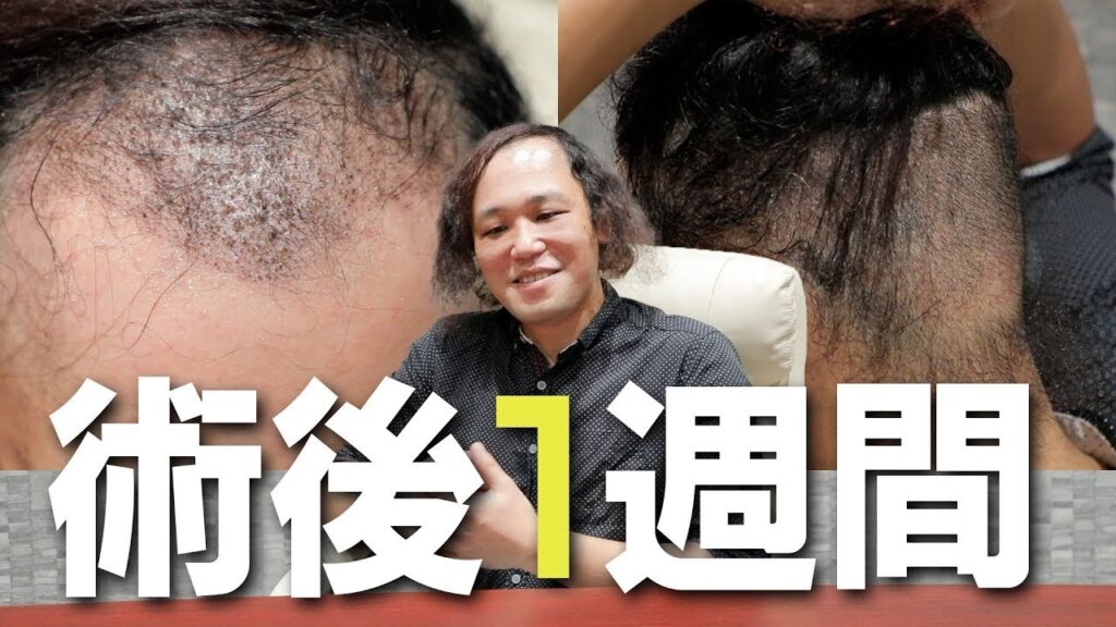 【植毛手術後1週間】モニター患者様のO様に手術後1週間の様子をインタビューさせて頂きました。