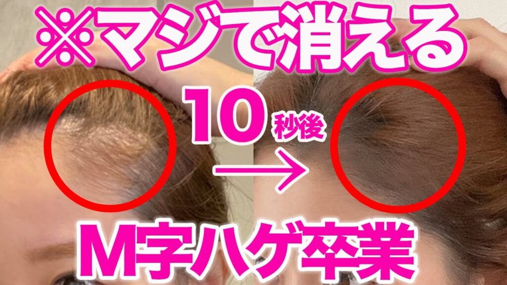 一瞬でM字ハゲを消す方法！小顔効果も抜群！