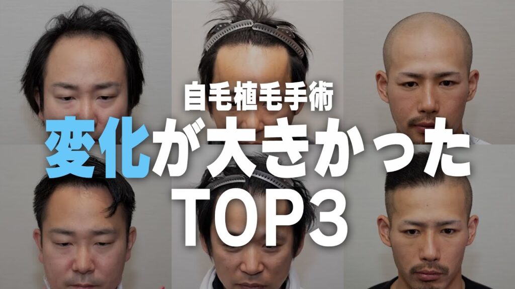 【自毛植毛】自毛植毛手術によって薄毛大改善TOP3