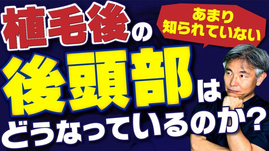 【視聴者様からの質問】植毛って後頭部から毛を取ると思うんですけど、大丈夫ですか？にお答えします。