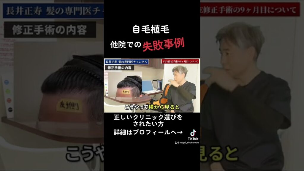 【悲報】他院で植毛失敗した方への修正オペの結果をご紹介します（9ヶ月後）＃shorts