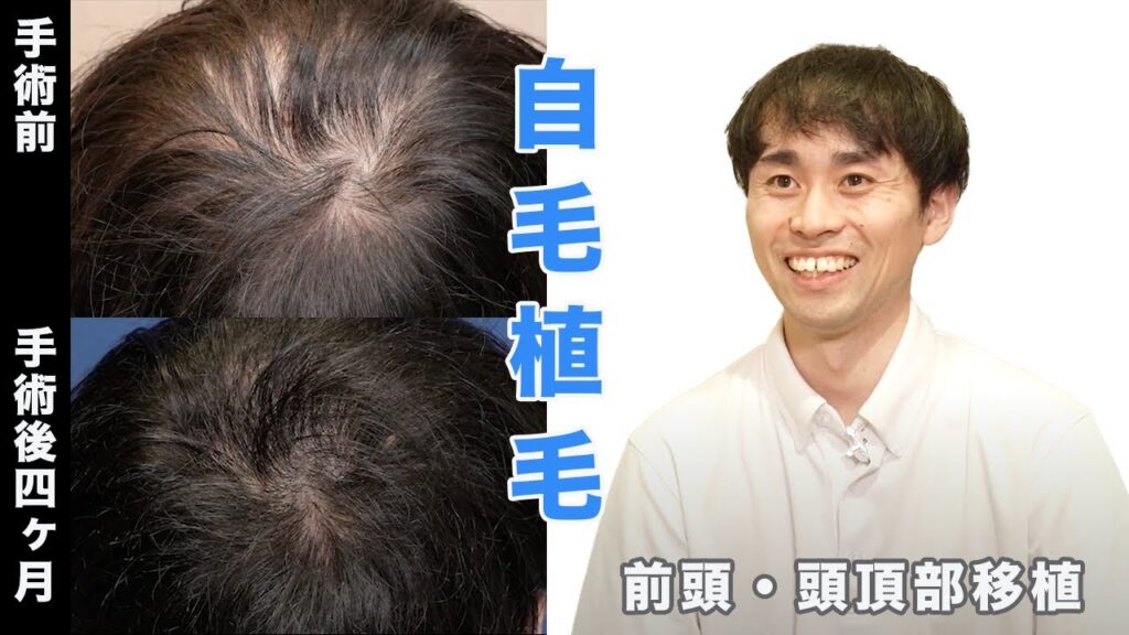 【植毛4ヶ月後 生え始め】前頭・頭頂部2000株移植 施術から4ヶ月後を追う。【自毛植毛】【植毛】
