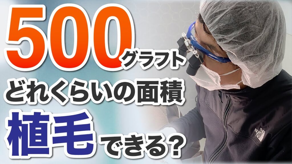 【自毛植毛】500グラフトで約○㎠の植毛ができます！オンライン植毛の湘南AGAクリニック新宿南口院