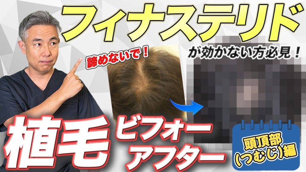 頭頂部の薄毛について