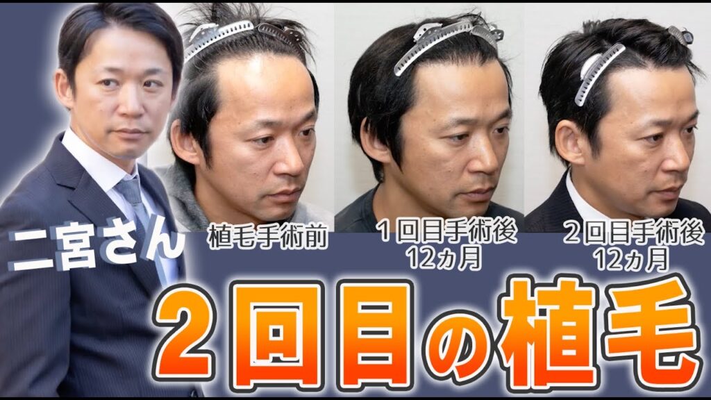 【自毛植毛】二宮祥平ホワイトベースさんの2度目の植毛手術後1年の経過をお伺いしました！【植毛】
