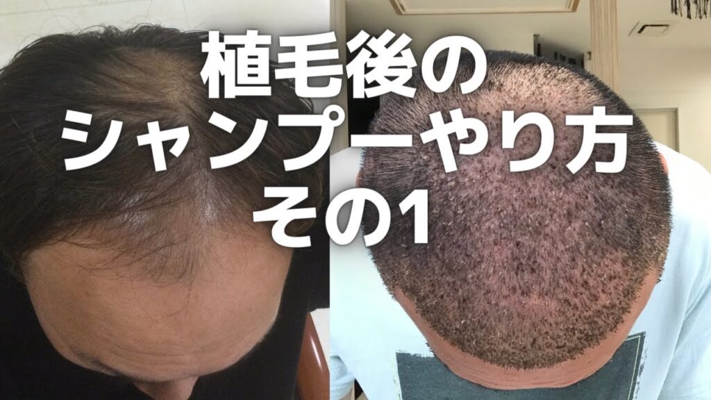 トルコ植毛美容師 植毛の秘訣教えます!! 植毛後のシャンプー方法 美容師歴25年美容師がトルコに行って植毛をやってみた。その後の記録を載せてみました。