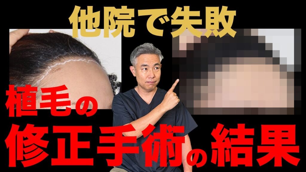 【他院での失敗】植毛した後、おでこが見せられなくなった方のお話