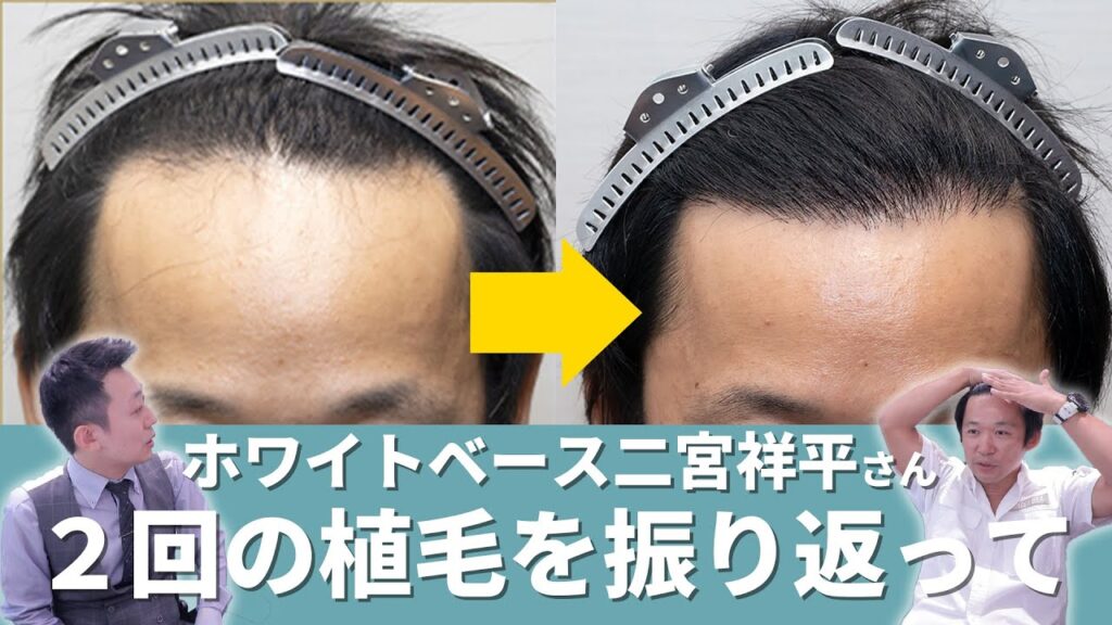 【自毛植毛 二宮祥平ホワイトベース】2度目の手術後から1年経過した二宮祥平さんにお話しを伺いました！【植毛】【薄毛治療】