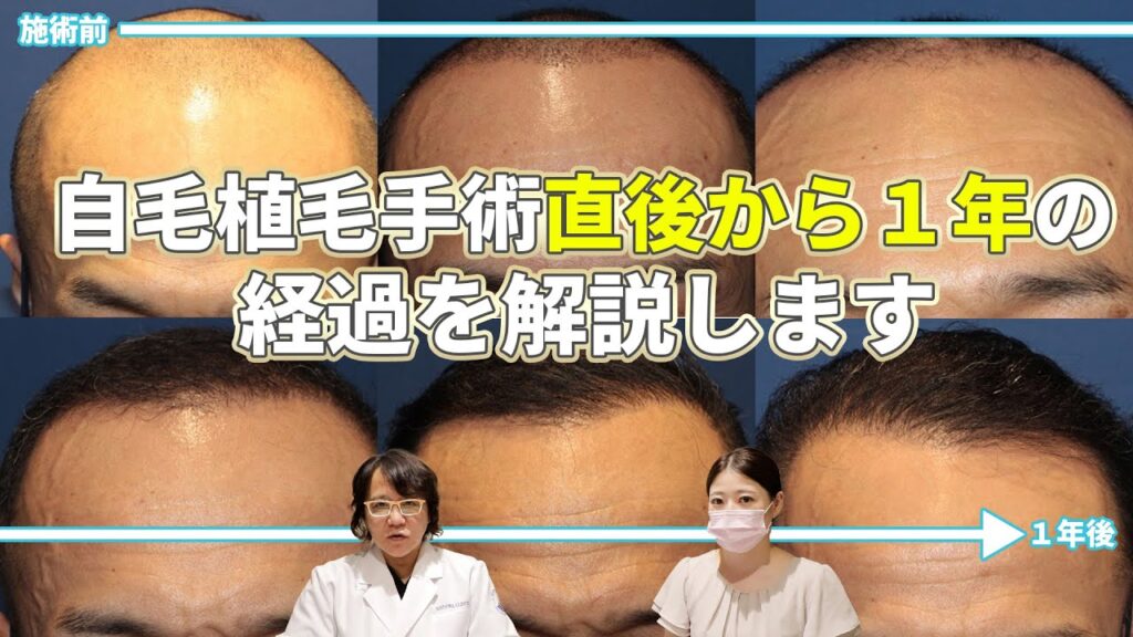 【自毛植毛】自毛植毛手術後から1年経過までの流れについて徹底解説!【植毛】【薄毛治療】