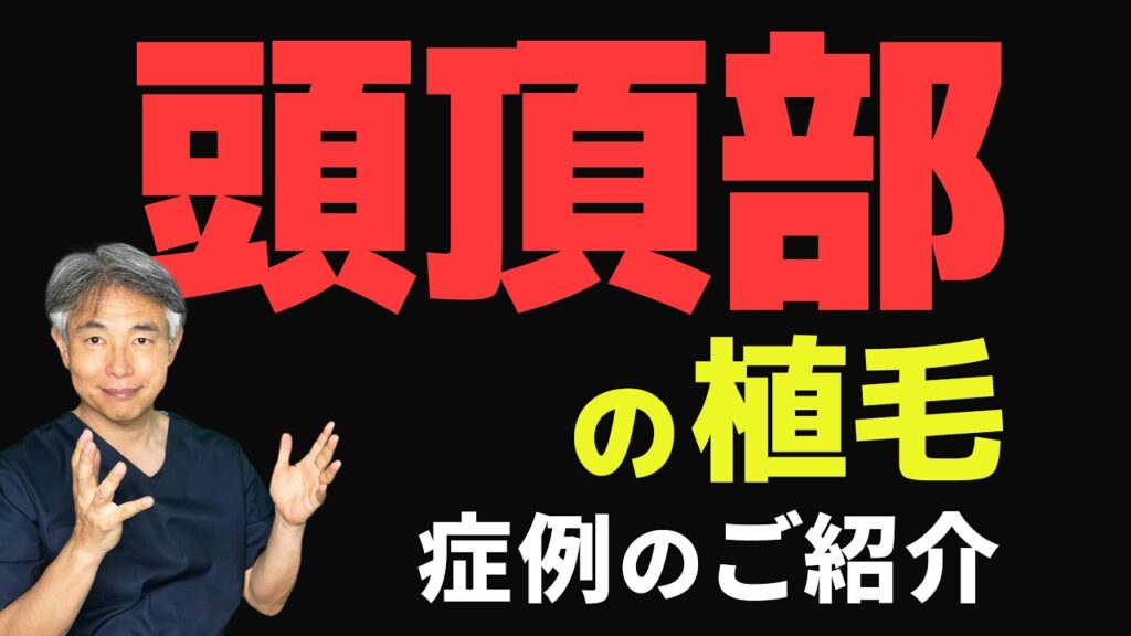 頭頂部の植毛について 剃るべき理由もお伝えします