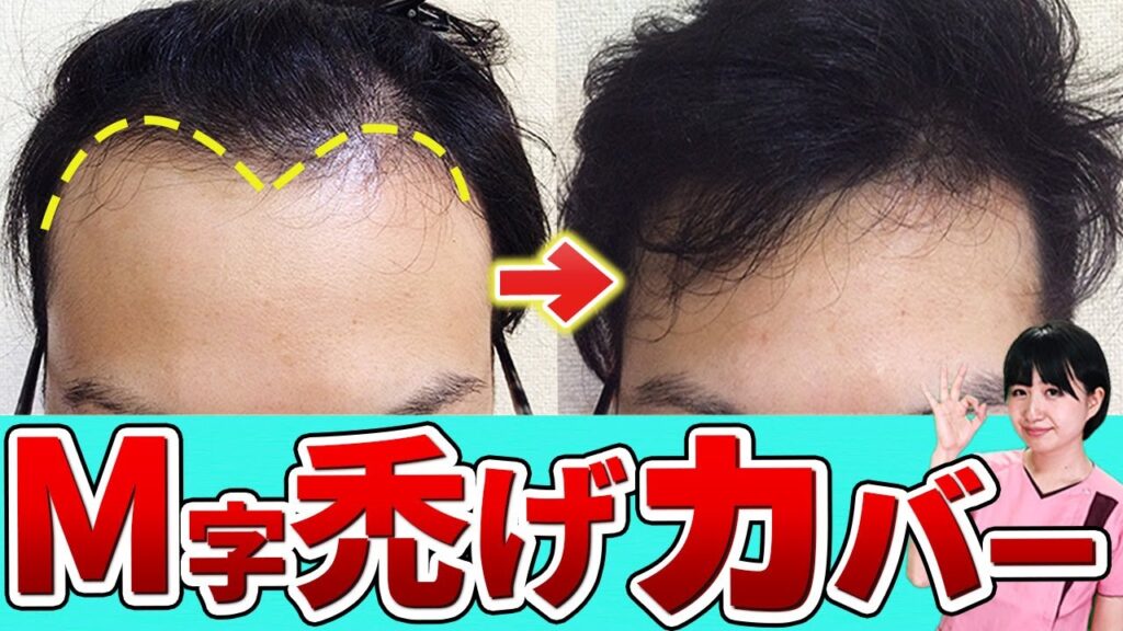 【M字・O字・U字】これらのハゲは髪型でカバーできます～薄毛が目立たない最適なヘアスタイルを発毛のプロが紹介～