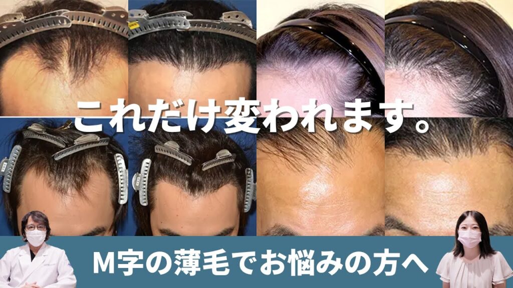 【自毛植毛】M字の薄毛にお悩みの方必見!自毛植毛手術の症例をご紹介します!【植毛】【薄毛治療】