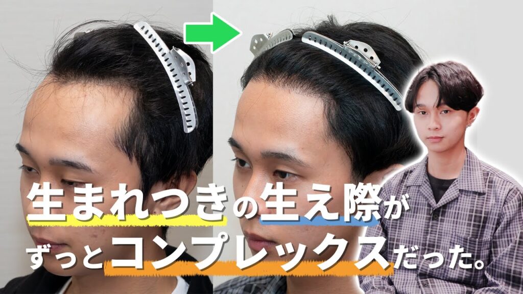 【自毛植毛1年経過】自毛植毛手術について、体験者のK様にお伺いしました！【薄毛治療】【植毛】