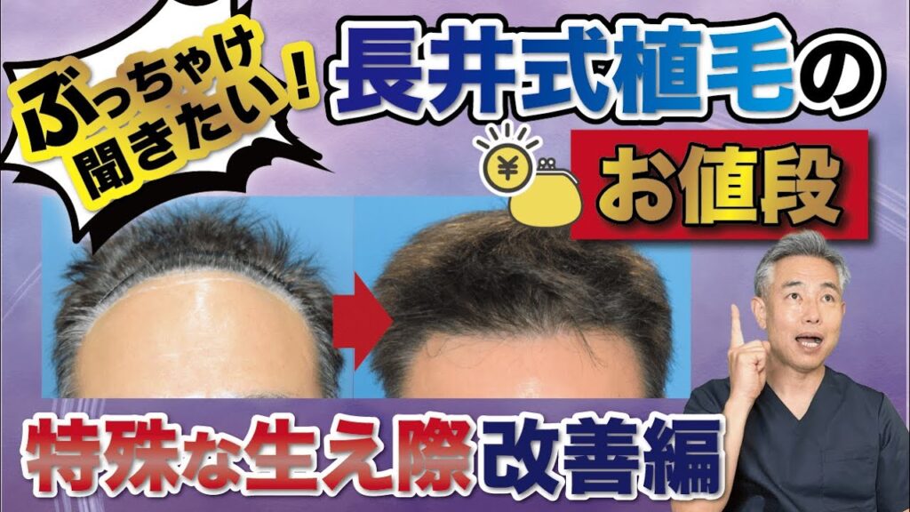 【生え際を大きく改善!!】長井式植毛のお値段も紹介
