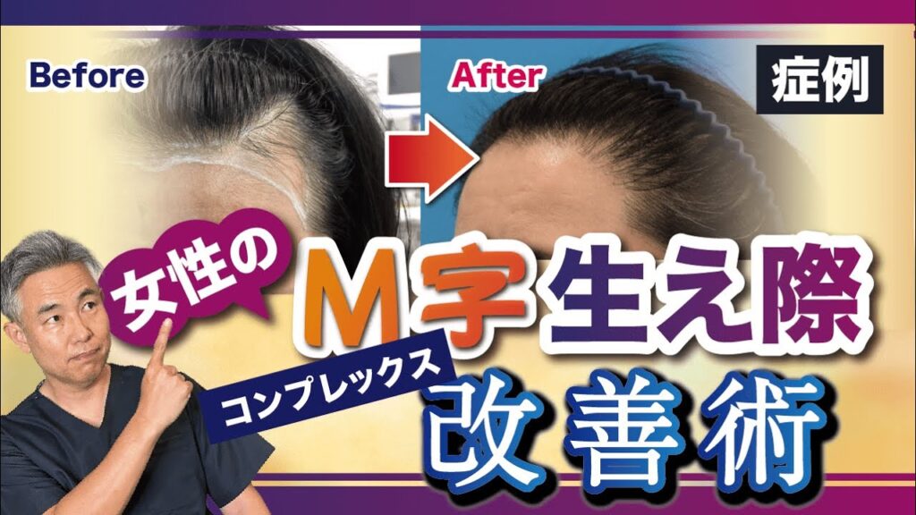 【女性のお悩み解決】M字生え際の改善症例