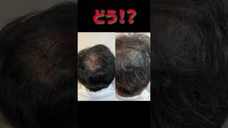 結局増毛して見た目が変わるの?#shorts #アデランス#増毛#beforeandafter