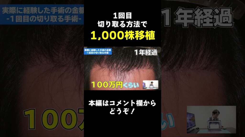 【植毛】自毛植毛にかかる手術費用について大解説！【自毛植毛】　#shorts