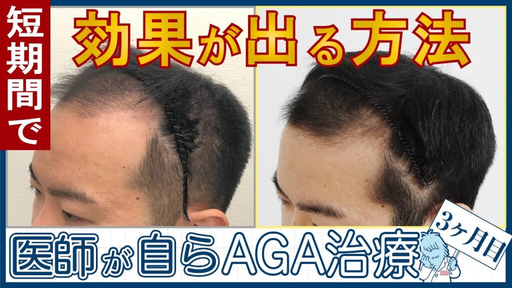 【薄毛治療3ヶ月目】AGA専門医師が自分の治療を体験&解説