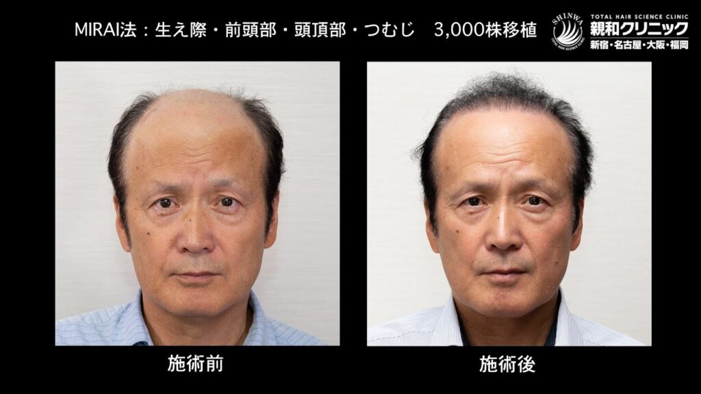 自毛植毛 体験インタビュー 植毛手術 から1年2ヶ月後の現在 かつらをつけない安堵感!実感しています【 親和クリニック 新宿 名古屋 大阪 福岡 】 【植毛】