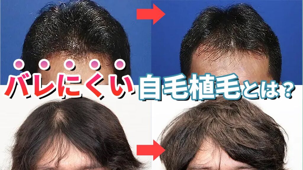 【自毛植毛】バレにくい自毛植毛手術の症例を専門医が徹底解説！【植毛】【薄毛治療】