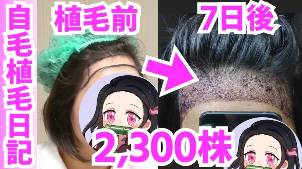 【女性の自毛植毛】トルコ植毛〜1週間後の経過【2,300株】