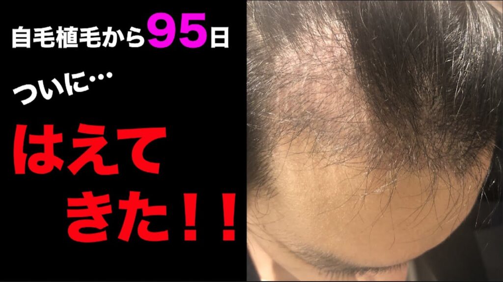 【自毛植毛から95日】ついに…ついに生えてきました!【AGA対策】
