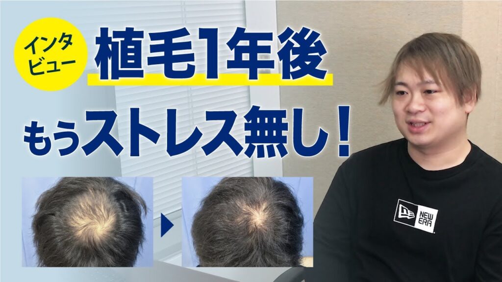 【インタビュー】自毛植毛手術〜1年経過 効果と変化について体験者「柴崎拓也さん」の感想