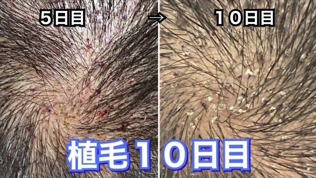 【植毛日記】手術から10日目