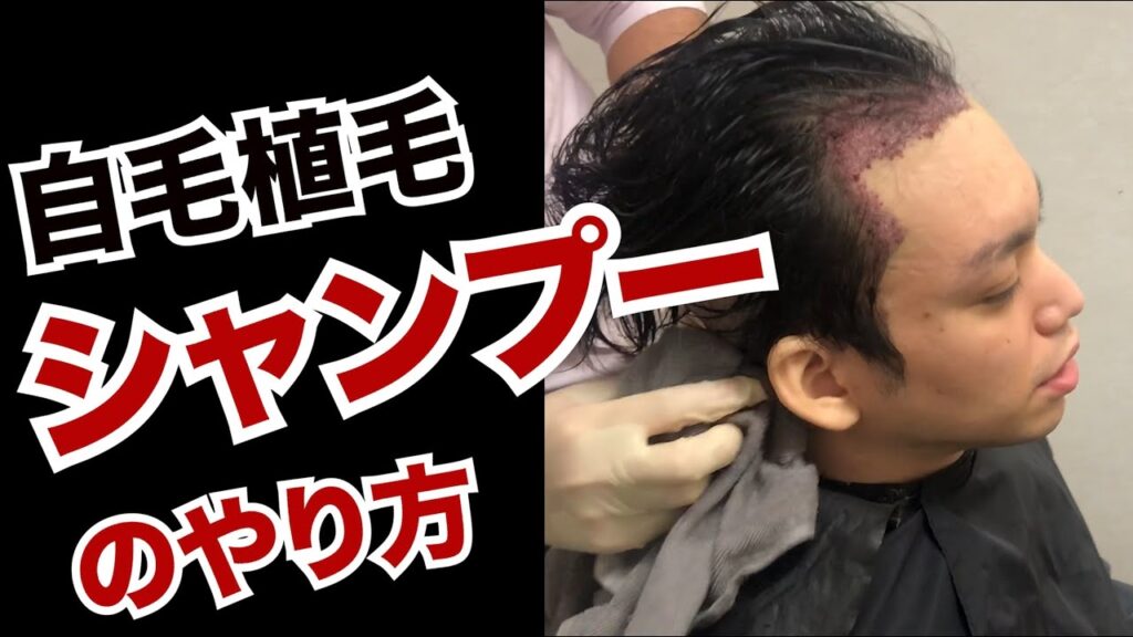 【AGA対策】自毛植毛してはじめてシャンプーします！