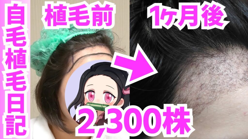 【女性の自毛植毛】トルコ植毛〜1ヶ月後の経過【2,300株】