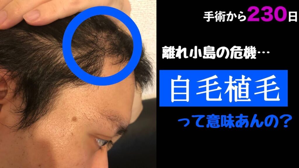 【手術から230日】頭頂部はAGAが進行…自毛植毛って本当に意味あんの?【AGA対策】