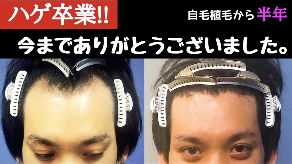 【自毛植毛から半年】ハゲ卒業!今までありがとうございました。【AGA】