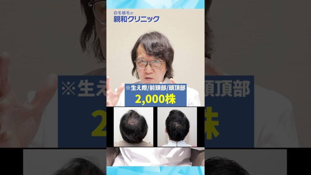 【自毛植毛】植毛手術で大改善された方をご紹介します! #Shorts