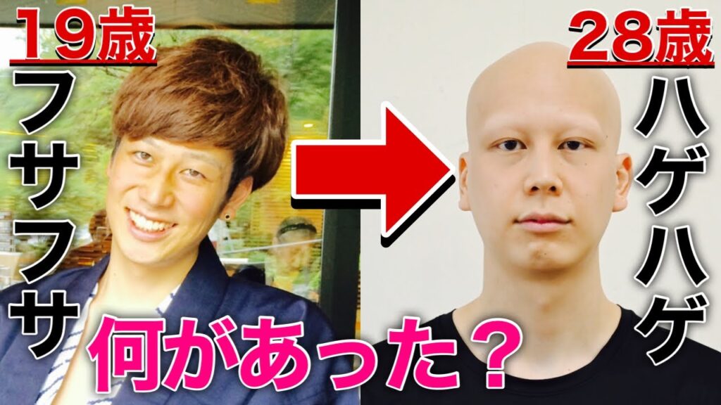 【脱毛症】ハゲるまでの過程大公開 写真で振り返る