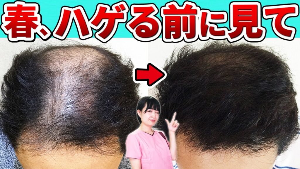 【抜け毛を減らす】今からするべき薄毛対策をプロが解説！