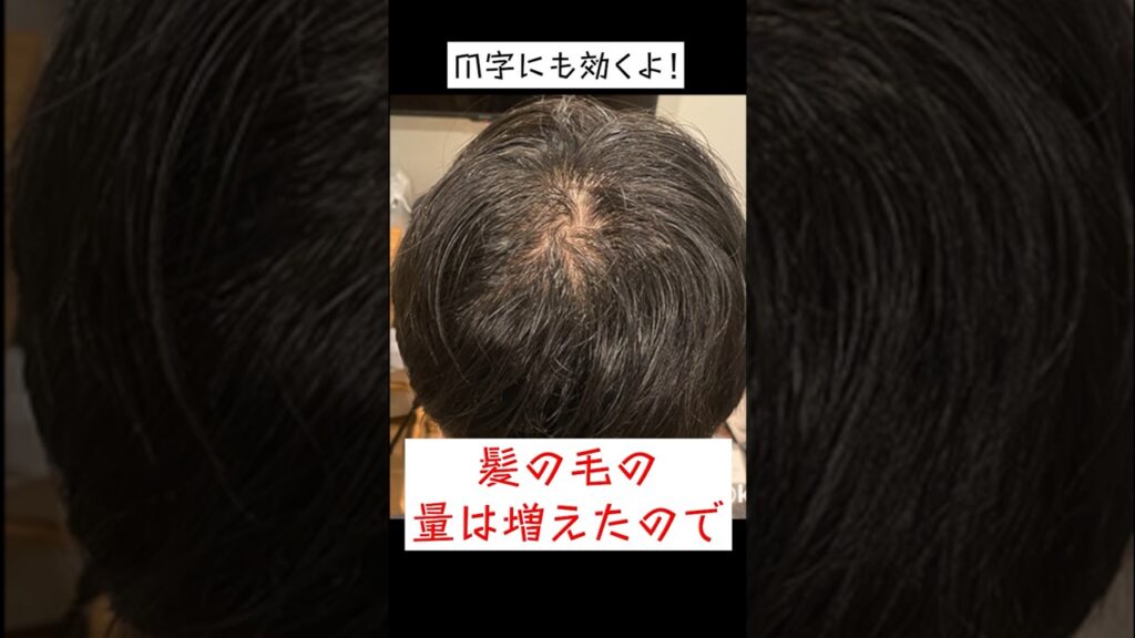 デュタステリドの薄毛治療効果がヤバすぎた #shorts
