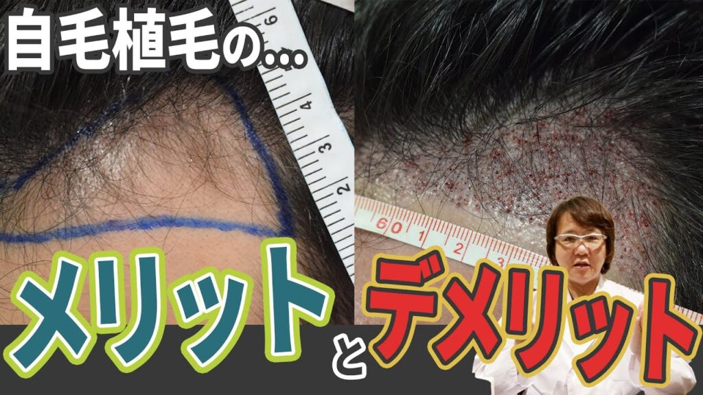 【自毛植毛】メリットとデメリット！FUTとFUEの違いを専門医が徹底解説！【薄毛】【植毛】